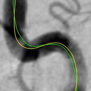 Fast Marching Minimal Path Extraction in ITK