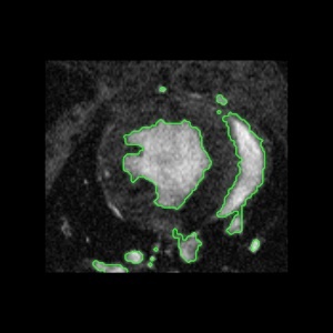 Level Set Segmentation: Active Contours without edge