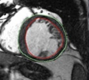 Evaluation Framework for Algorithms Segmenting Short Axis Cardiac MRI.