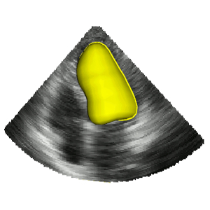 Clinical Expert Delineation of 3D Left Ventricular Echocardiograms for the CETUS Segmentation Challenge
